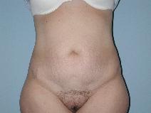 Tummy Tuck Before Photo by Raymond Mockler, MD; Panama City, FL - Case 9480