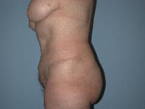 Tummy Tuck After Photo by Raymond Mockler, MD; Panama City, FL - Case 9481