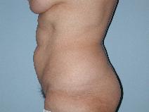 Tummy Tuck Before Photo by Raymond Mockler, MD; Panama City, FL - Case 9481