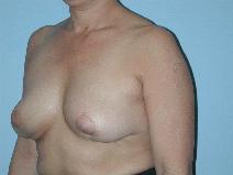 Breast Lift Before Photo by Raymond Mockler, MD; Panama City, FL - Case 9495