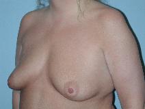 Breast Augmentation Before Photo by Raymond Mockler, MD; Panama City, FL - Case 9499
