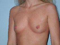 Breast Augmentation Before Photo by Raymond Mockler, MD; Panama City, FL - Case 9521