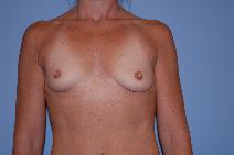 Breast Augmentation Before Photo by Raymond Mockler, MD; Panama City, FL - Case 9571