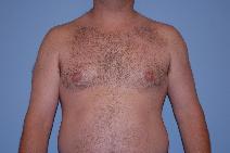 Male Breast Reduction Before Photo by Raymond Mockler, MD; Panama City, FL - Case 9669