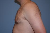 Male Breast Reduction After Photo by Raymond Mockler, MD; Panama City, FL - Case 9669