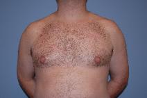 Male Breast Reduction Before Photo by Raymond Mockler, MD; Panama City, FL - Case 9669