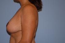 Breast Reduction After Photo by Raymond Mockler, MD; Panama City, FL - Case 9670