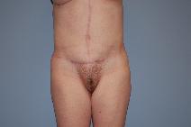 Tummy Tuck After Photo by Raymond Mockler, MD; Panama City, FL - Case 9671