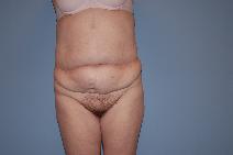 Tummy Tuck Before Photo by Raymond Mockler, MD; Panama City, FL - Case 9671