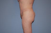 Tummy Tuck After Photo by Raymond Mockler, MD; Panama City, FL - Case 9671