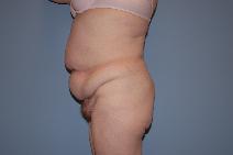 Tummy Tuck Before Photo by Raymond Mockler, MD; Panama City, FL - Case 9671