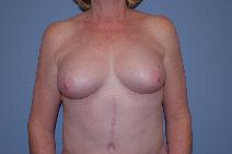 Breast Augmentation After Photo by Raymond Mockler, MD; Panama City, FL - Case 9672