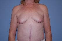Breast Augmentation Before Photo by Raymond Mockler, MD; Panama City, FL - Case 9672