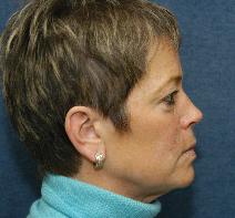 Eyelid Surgery Before Photo by Ian Bourhill, MD; Huntington, NY - Case 9859