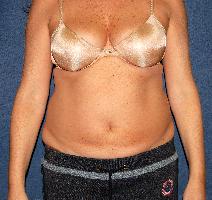Liposuction Before Photo by Ian Bourhill, MD; ,  - Case 9967
