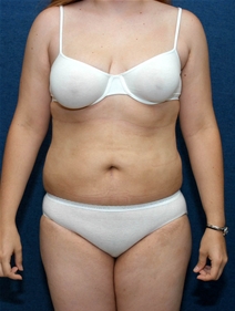 Liposuction After Photo by Ian Bourhill, MD; ,  - Case 9967