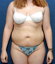 Liposuction Before Photo by Ian Bourhill, MD; ,  - Case 9967