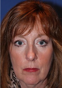Eyelid Surgery After Photo by Joseph Daw, MD; Naperville, IL - Case 34000
