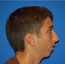 Chin Augmentation Before Photo by Joseph Daw, MD; Naperville, IL - Case 34001