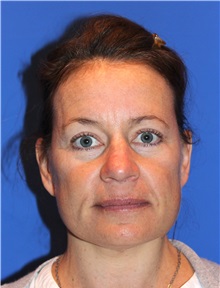 Facelift After Photo by Joseph Daw, MD; Naperville, IL - Case 34007