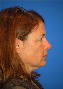 Facelift Before Photo by Joseph Daw, MD; Naperville, IL - Case 34007