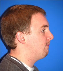 Rhinoplasty After Photo by Joseph Daw, MD; Naperville, IL - Case 34008