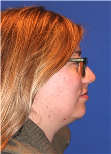 Chin Augmentation Before Photo by Joseph Daw, MD; Naperville, IL - Case 34009