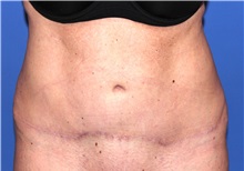 Tummy Tuck After Photo by Joseph Daw, MD; Naperville, IL - Case 34010