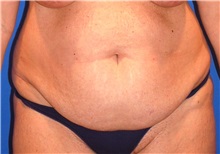 Tummy Tuck Before Photo by Joseph Daw, MD; Naperville, IL - Case 34010