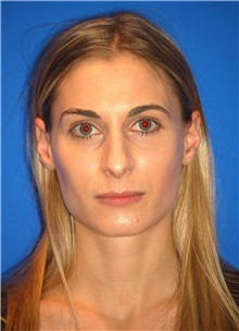 Rhinoplasty Before Photo by Joseph Daw, MD; Naperville, IL - Case 34011