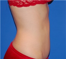 Tummy Tuck After Photo by Joseph Daw, MD; Naperville, IL - Case 35154