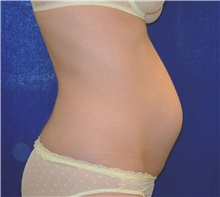 Tummy Tuck Before Photo by Joseph Daw, MD; Naperville, IL - Case 35154