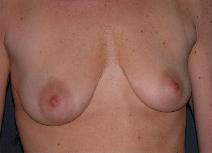 Breast Augmentation Before Photo by Thomas Hagerty, MD; Kingston, NY - Case 9235