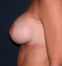 Breast Augmentation After Photo by Thomas Hagerty, MD; Kingston, NY - Case 9235