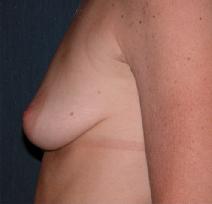 Breast Augmentation Before Photo by Thomas Hagerty, MD; Kingston, NY - Case 9235