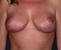 Breast Lift After Photo by Thomas Hagerty, MD; Kingston, NY - Case 9237