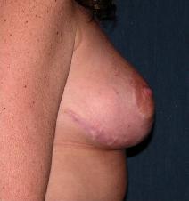 Breast Lift After Photo by Thomas Hagerty, MD; Kingston, NY - Case 9237