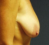 Breast Lift Before Photo by Thomas Hagerty, MD; Kingston, NY - Case 9237