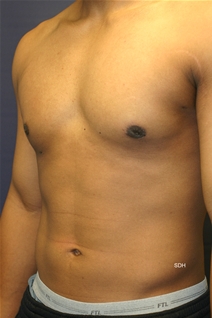 Male Breast Reduction After Photo by Scott Holley, MD; Portage, MI - Case 20565