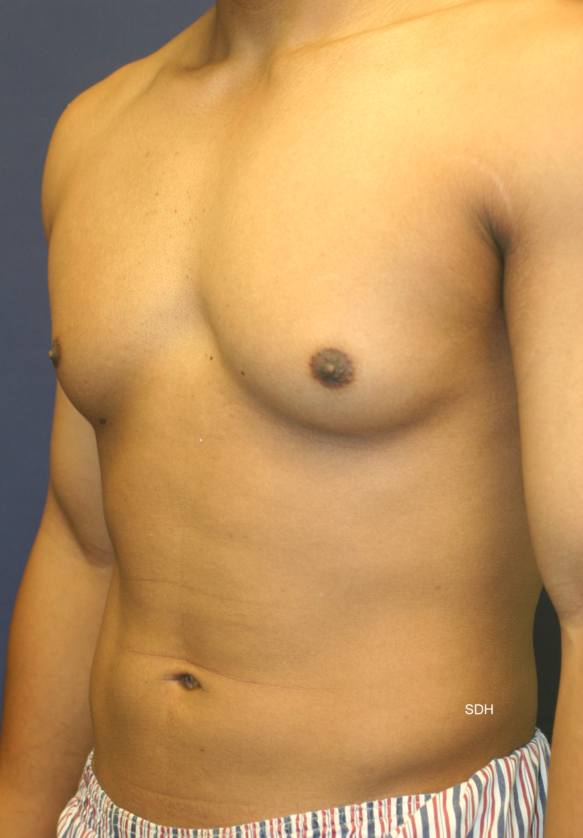 Male Breast Reduction Before and After Photos by Scott Holley MD