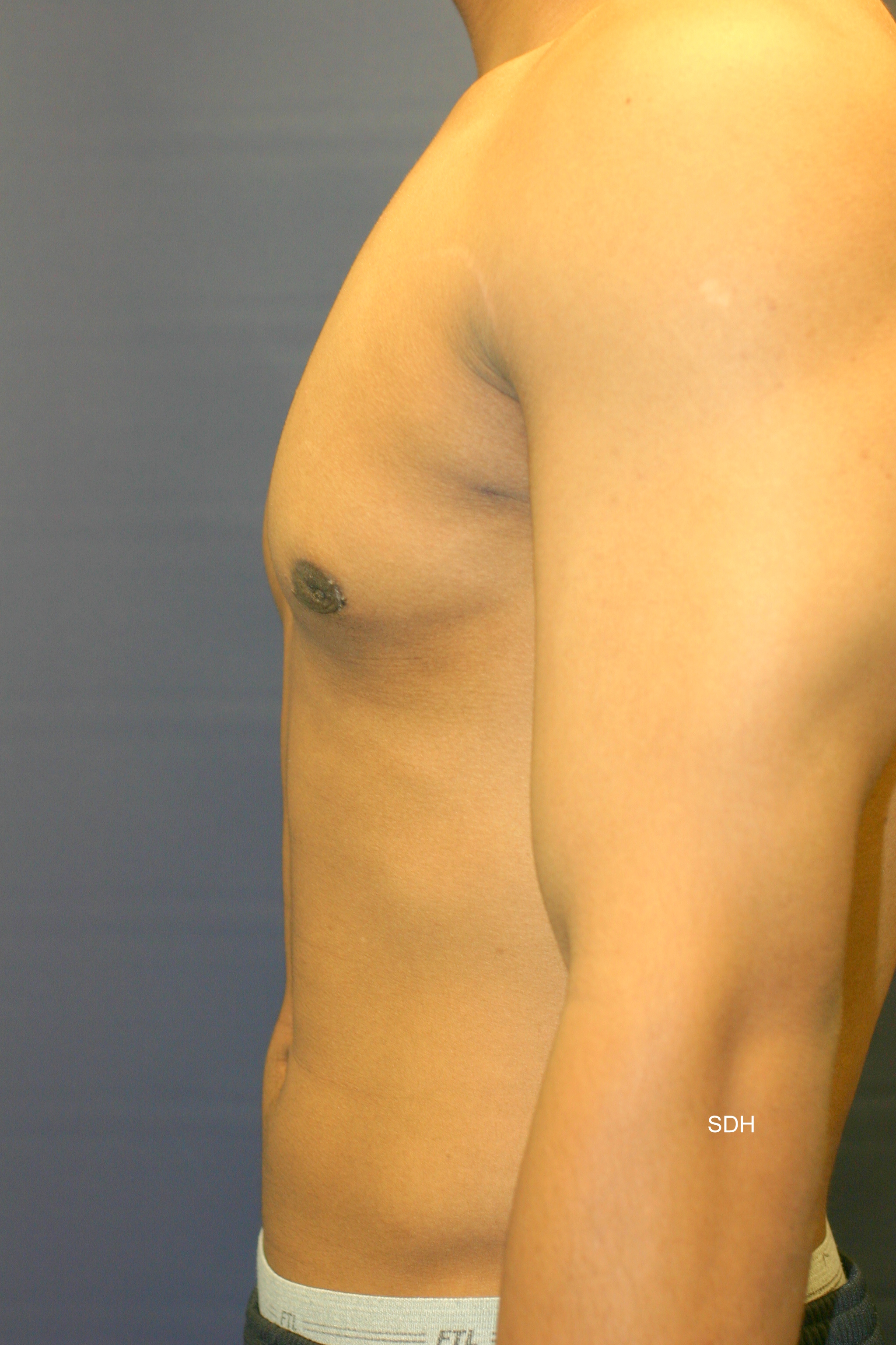 Male Breast Reduction Before and After Photos by Scott Holley MD