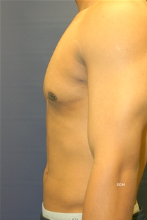 Male Breast Reduction After Photo by Scott Holley, MD; Portage, MI - Case 20565