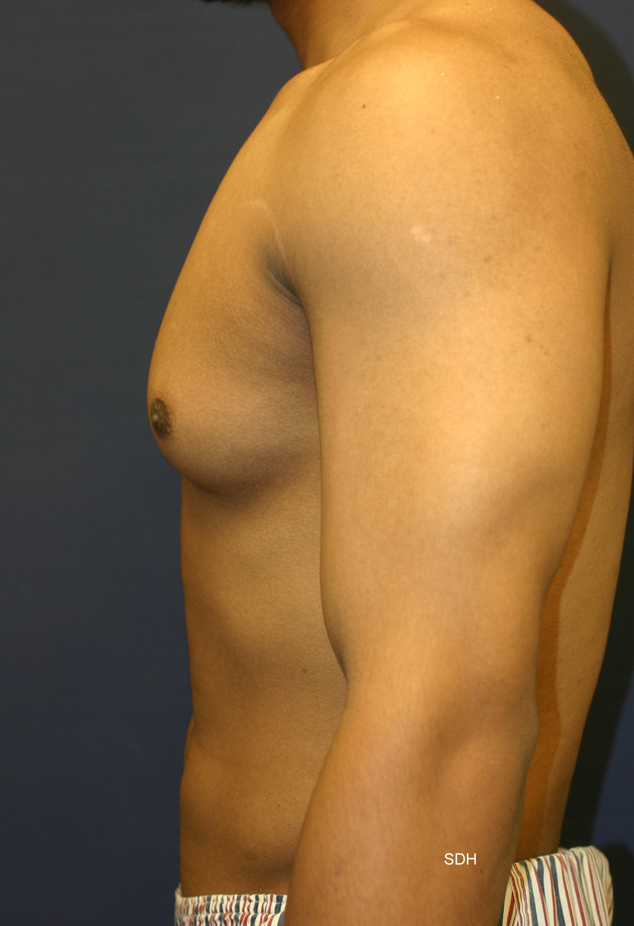 Male Breast Reduction Before and After Photos by Scott Holley MD