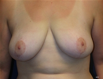 Breast Reduction After Photo by Scott Holley, MD; Portage, MI - Case 20742