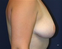 Breast Reduction After Photo by Scott Holley, MD; Portage, MI - Case 20742
