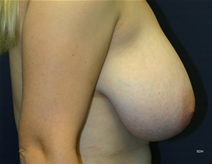 Breast Reduction Before Photo by Scott Holley, MD; Portage, MI - Case 20742