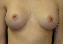 Breast Augmentation After Photo by Scott Holley, MD; Portage, MI - Case 7762