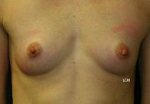 Breast Augmentation Before Photo by Scott Holley, MD; Portage, MI - Case 7762