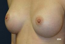 Breast Augmentation After Photo by Scott Holley, MD; Portage, MI - Case 7762