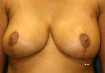 Breast Reduction After Photo by Scott Holley, MD; Portage, MI - Case 7765